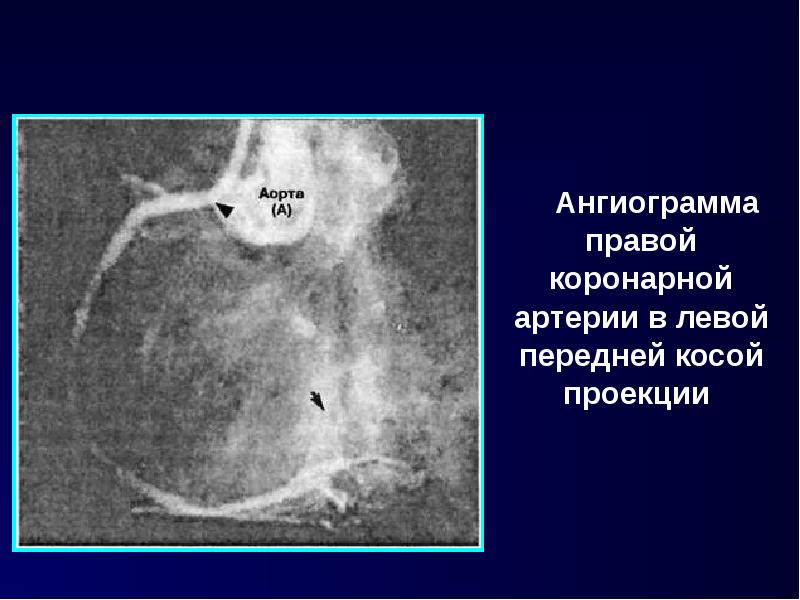Ангиограмма правой коронарной артерии в левой передней косой проекции Ангиограмма правой коронарной