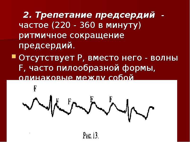 Дефицит пульса. Неритмированная форма трепетания предсердий. Ритмичное трепетание предсердий. Ф волны при трепетании предсердий. Трепетание предсердий с проведением 2 1.