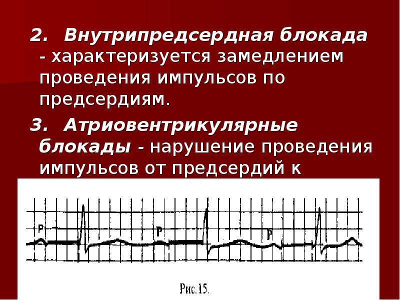 Замедление проводимости. Внутрипредсердная блокада 3 степени ЭКГ. 3 Степень внутрипредсердной блокады ЭКГ. Внутрипредсердная блокада на ЭКГ характеризуется. ЭКГ при внутрипредсердной блокаде.