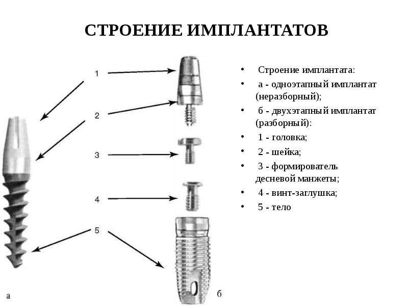 Как делается имплантация зубов на схеме покажите