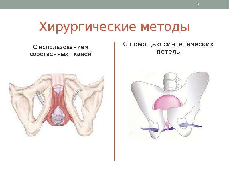 Пролапс тазовых органов презентация