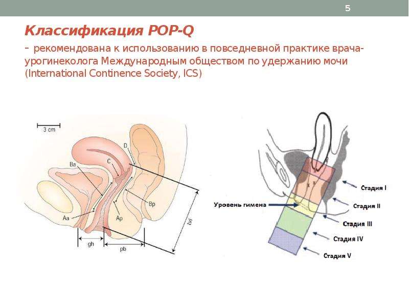 Пролапс тазовых органов презентация