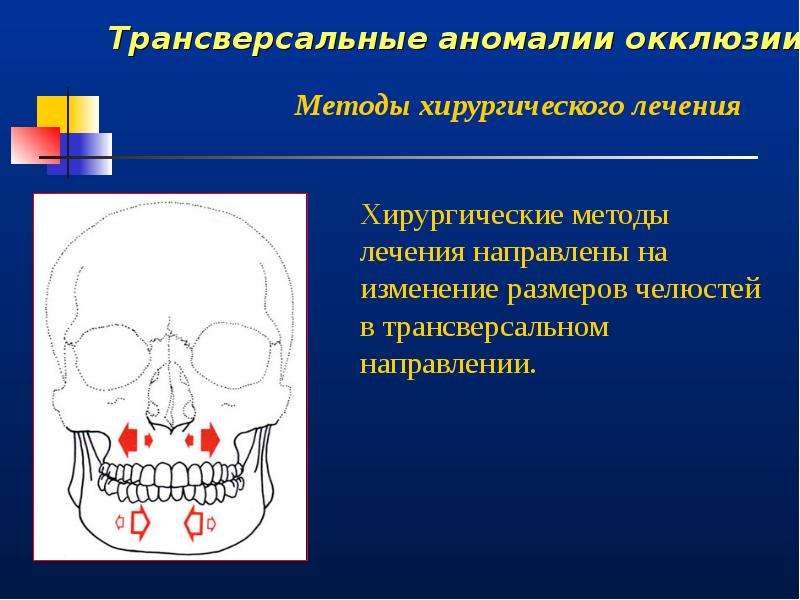 Правая окклюзия. Трансверсальные аномалии прикуса. Трансверсальная окклюзия. Трансверсальная резцовая окклюзия. Трансверсальные аномалии окклюзии.