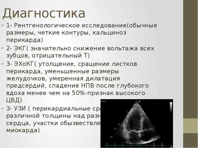 Эхо данные. Констриктивный перикардит ЭХОКГ. Выпотной перикардит ЭХОКГ. Экссудативный перикардит ЭХОКГ. ЭХОКГ норма жидкости в перикарде.