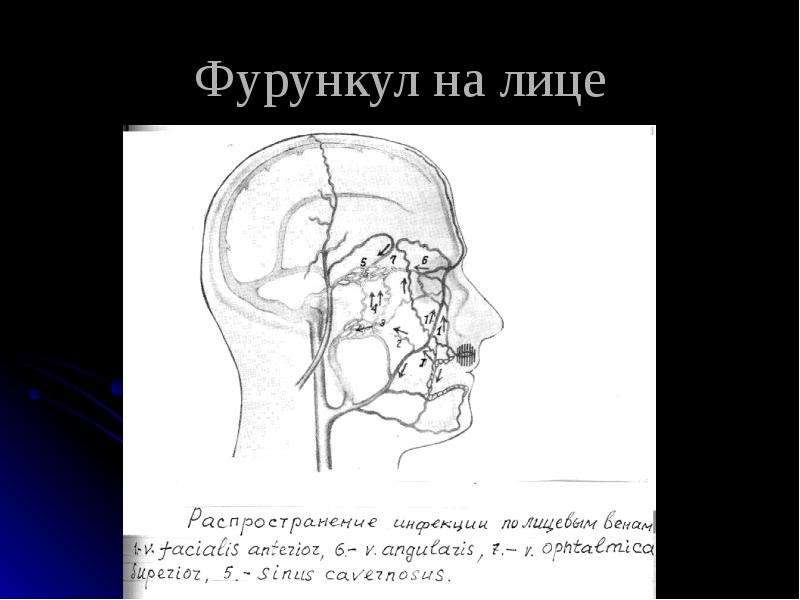 Нагноительные заболевания легких презентация