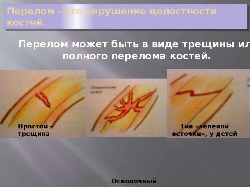 Тип зеленой веточки. Виды трещин. Полный перелом и трещина.