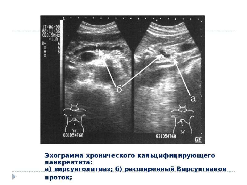 Сестринская помощь при остром панкреатите презентация