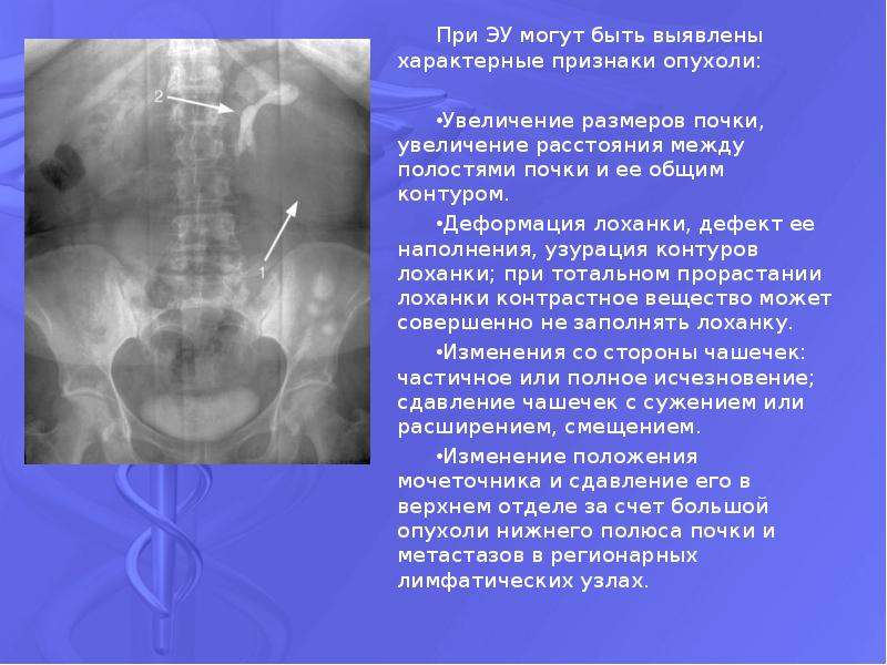 Гидронефроз презентация урология