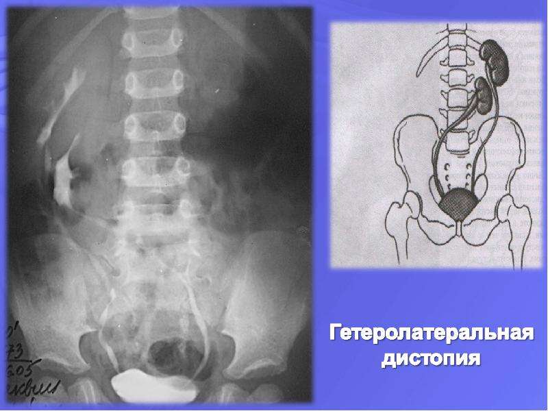 Нефроптоз дистопия. Лучевая диагностика в урологии.