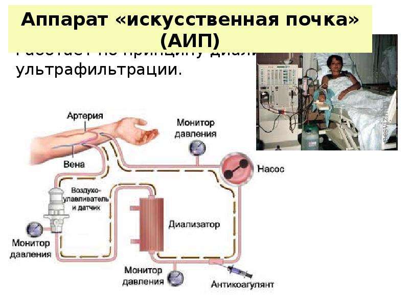 Принцип работы аппарата искусственная почка рисунок