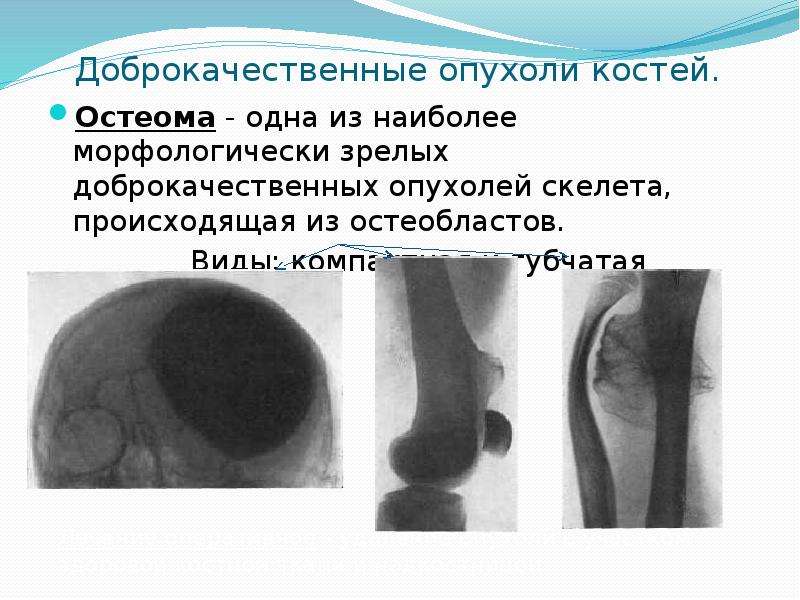 Доброкачественные опухоли костей презентация