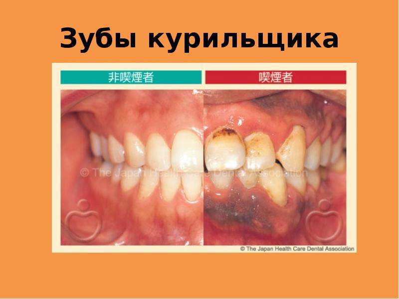Зубы курильщика