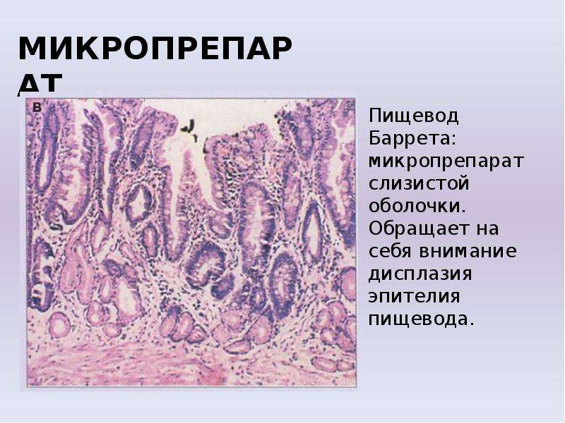 Фиброма пищевода микропрепарат рисунок