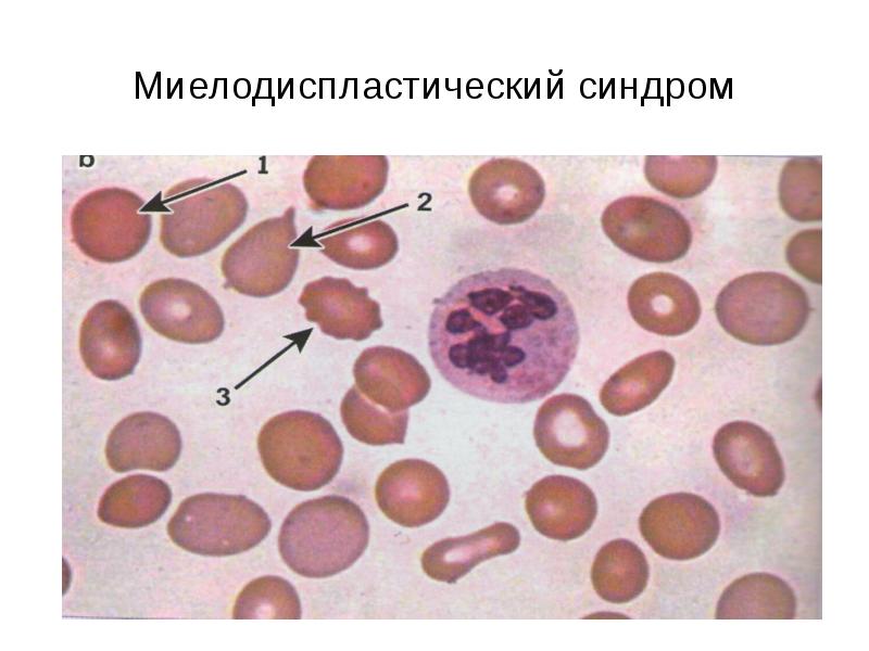 Миелодиспластический синдром презентация