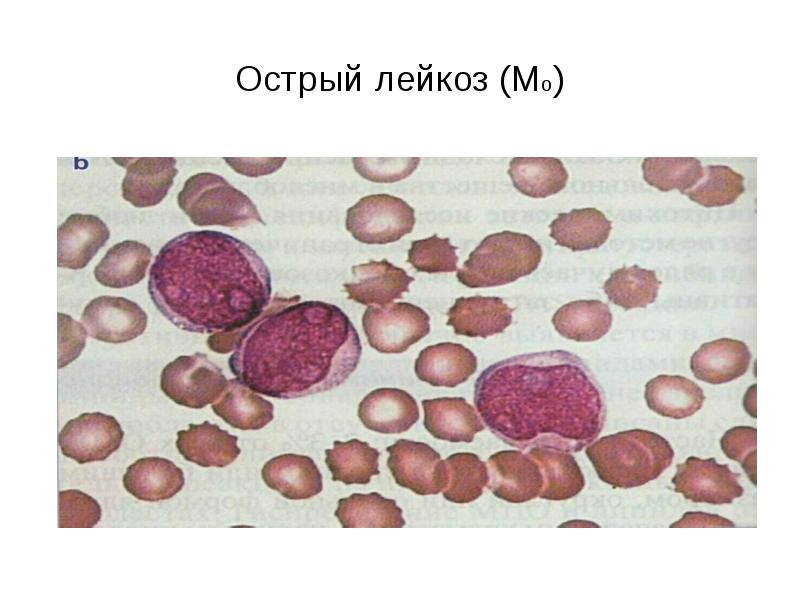 Острый лейкоз фото клеток