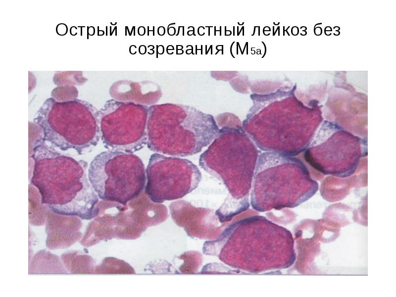 Картина острого лейкоза