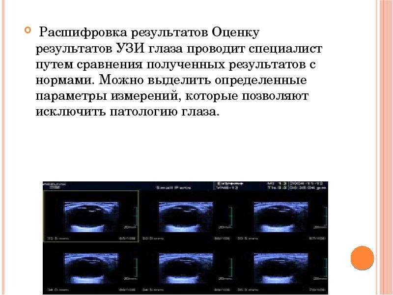 Ока расшифровка. УЗИ биомикроскопия глаза. Биомикроскопия глаза результат. УЗИ глаз расшифровка результатов.