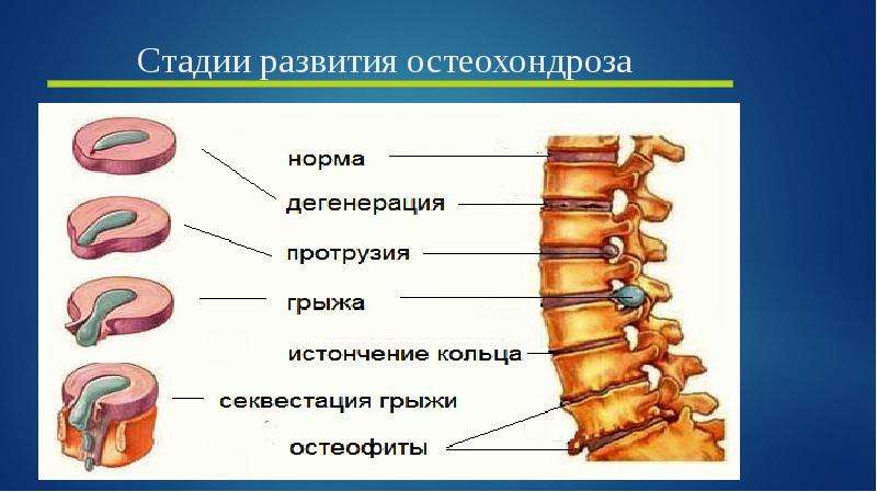 Степени остеохондроза. Стадии остеохондроза. Стадии развития остеохондроза. Стадии формирования остеохондроза. Периоды развития остеохондроза.