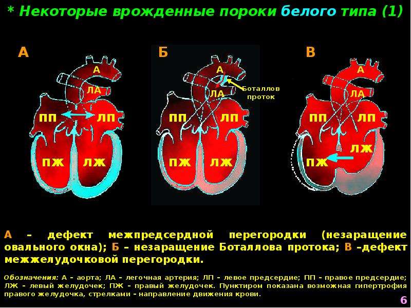 Перегрузка сердца. Пороки сердца белого типа. Врожденные пороки сердца белого типа. Белые и синие пороки сердца у детей. Врождённые пороки сердца белые пороки.