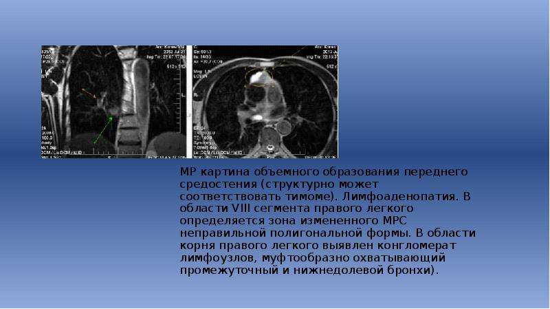 Объемное образование. Картина объемного образования. Кт объемное образование образование в легком. Образования переднего средостения. Объемное образование правого корня легкого.