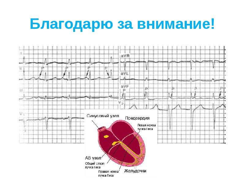 Ав блокада презентация