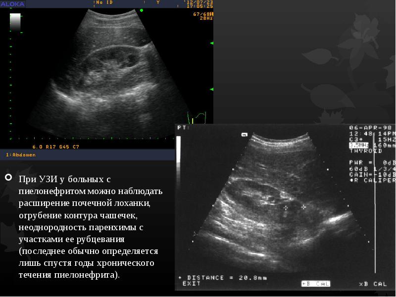 Пиелонефрит узи картина