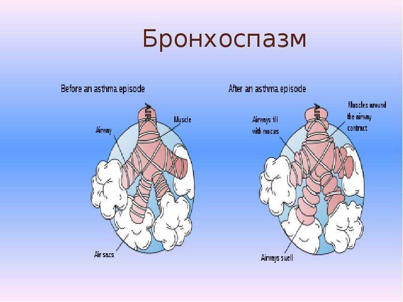 Бронхоспазм. Парадоксальный бронхоспазм. Бронхоспазм патогенез.