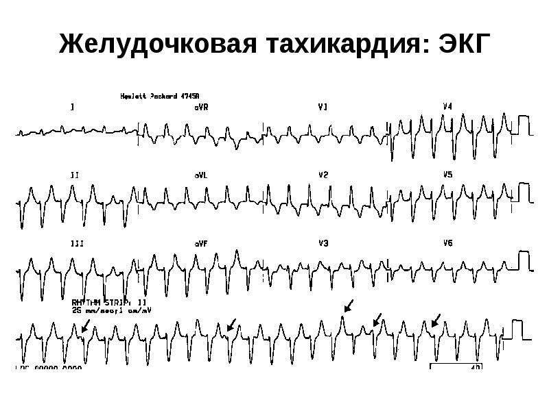 Фото желудочковая тахикардия