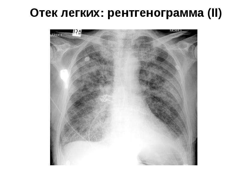 Отек легкого презентация