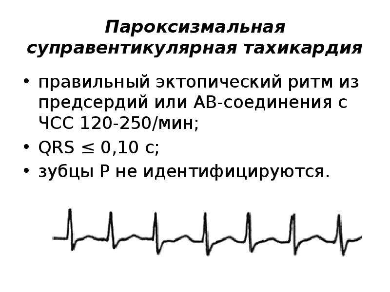 Ритм из ав соединения