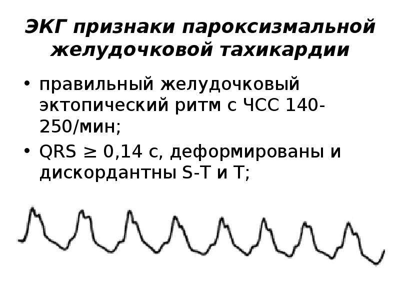 Признаки тахикардии на экг. ЭКГ при желудочковой пароксизмальной тахикардии. Пароксизмальная тахикардия ЭКГ расшифровка. Расшифровка ЭКГ при желудочковой тахикардии. Желудочковая и синусовая тахикардия на ЭКГ.