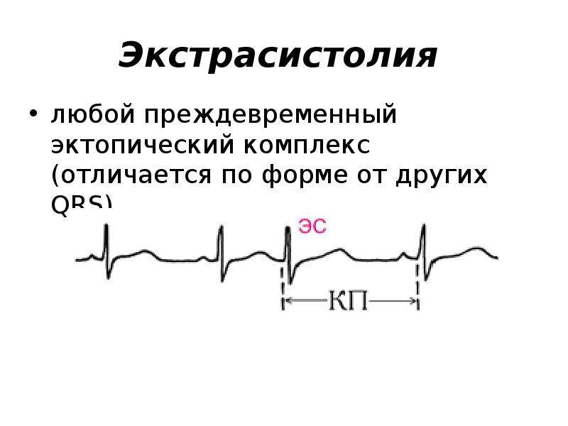 Экстрасистолия сердца что. Экстрасистолия нарушение проводимости. Нарушение ритма экстрасистолия. Эктопическая экстрасистола. Экстрасистолия ритм.