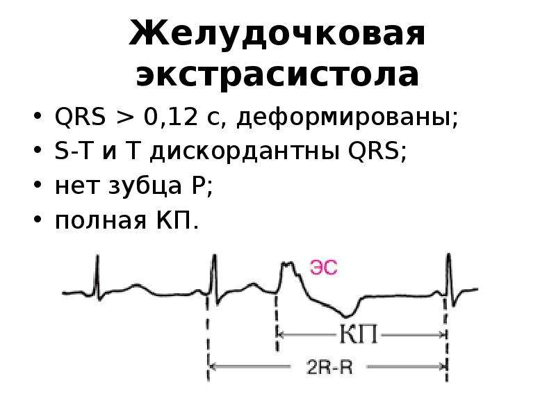 1 желудочковая экстрасистола. Желудочковая экстрасистола r на t. ЭКГ-критерий желудочковой экстрасистолии. Желудочковая экстрасистолия на ЭКГ признаки. Графики экстрасистолы.