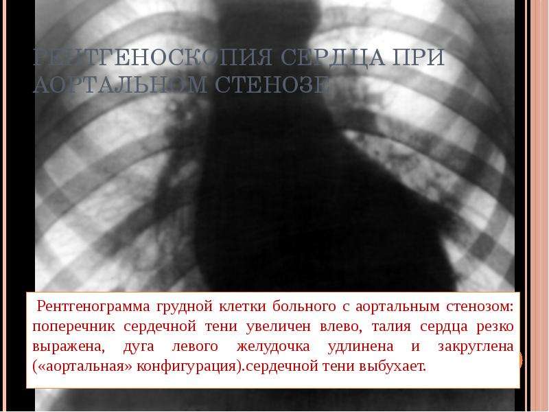 Расширение сердца влево. Рентгенография грудной клетки поперечник. Поперечник сердца на рентгенограмме. Рентгенография грудной клетки при аортальном стенозе. Сердечная тень расширена влево.