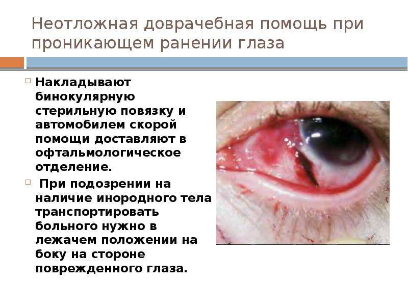 Неотложная доврачебная помощь при проникающем ранении глаза Накладывают бинокулярную стерильную повя