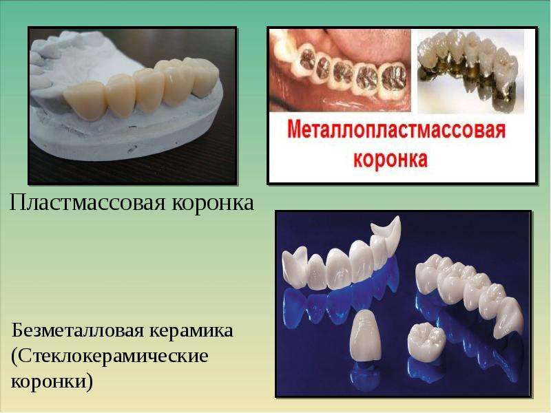 Презентация безметалловая керамика