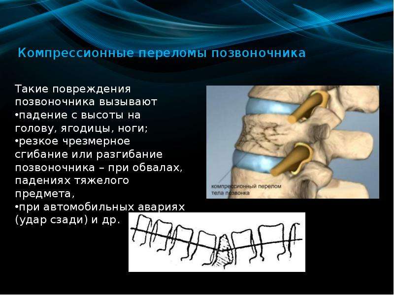   Компрессионные переломы позвоночника
