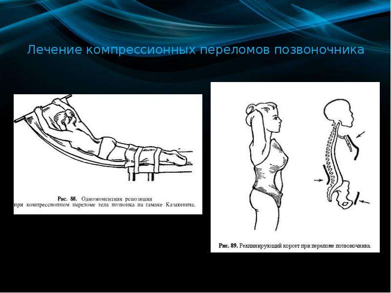   Лечение компрессионных переломов позвоночника
