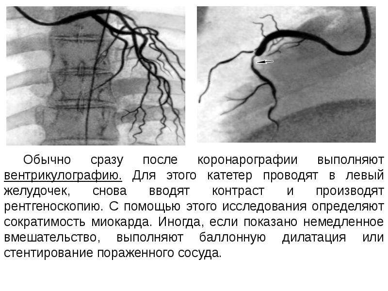 Сосуды сердца схема коронарография