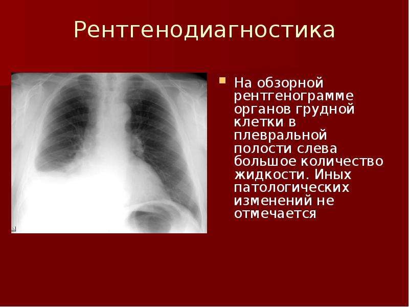 Без полости. Обзорная рентгенограмма органов грудной клетки. Обзорная рентгенограмма грудной полости. Органы грудной полости без патологических изменений. Органы грудной клетки без патологических изменений.