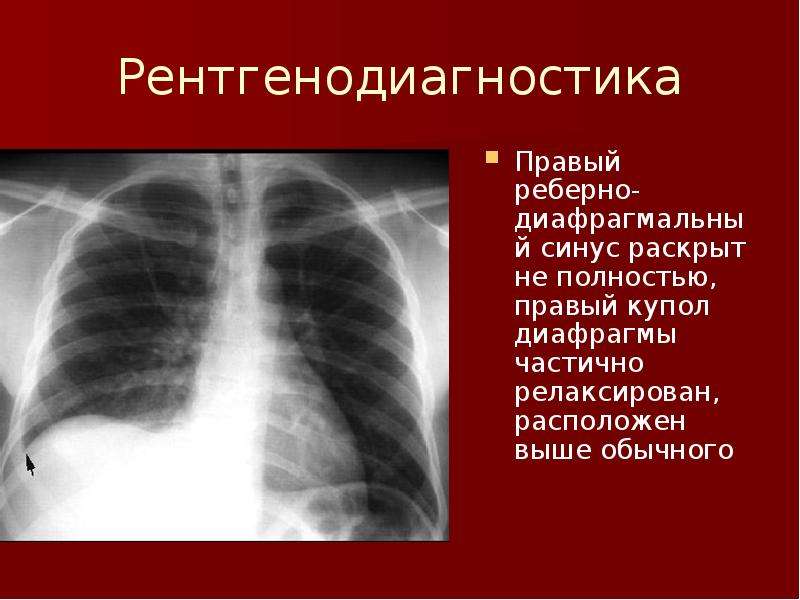 Оба справа. Реберно-диафрагмальный синус рентген. Диафрагмальный медиастинальный синус. Диафрагмально средостенный синус. Правый реберно диафрагмальный синус.