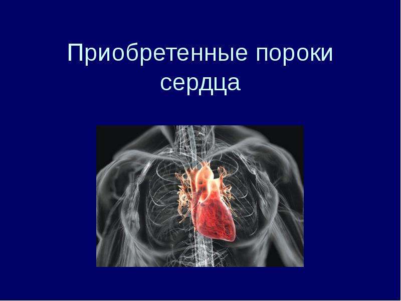 Доклад: Пороки сердца приобретенные