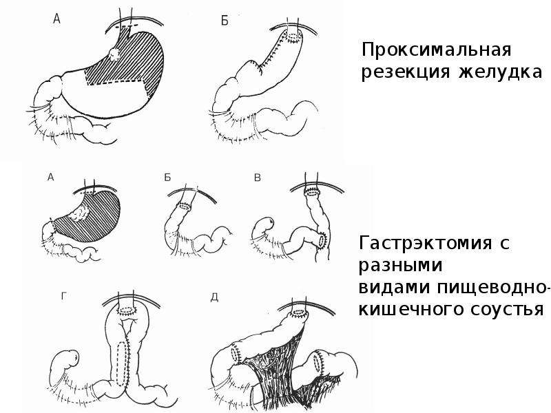 2 3 желудка. Трубчатая резекция желудка. Проксимальная резекция желудка схема. Резекция желудка виды операций. Тотальная резекция желудка.