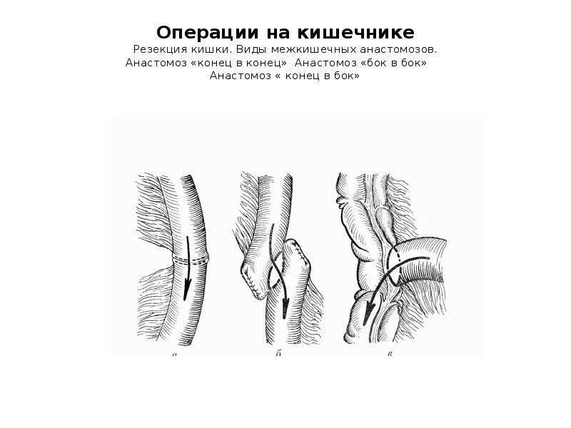 Операция 8. Типы кишечных анастомозов. Кишечные анастомозы схема. Техника резекции тонкой кишки с анастомозом «конец в конец». Виды межкишечных анастомозов.