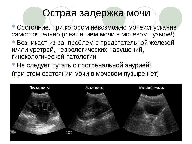 Схема задержка мочи