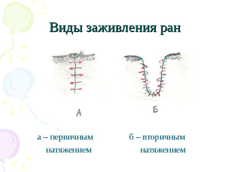 Заживление раны быстро. Заживление раны вторичным натяжением. Заживление РАН первичным натяжением. Рана зажила первичным натяжением. Первичное и вторичное заживление раны.