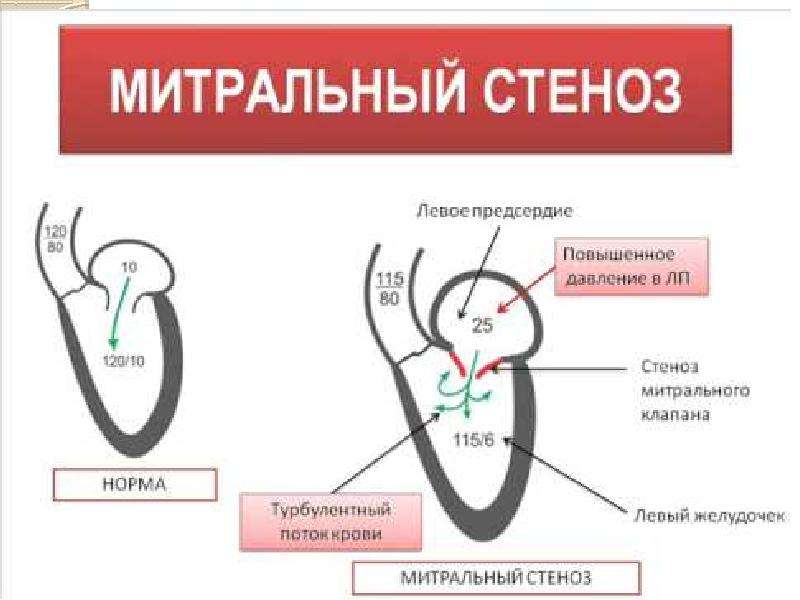 Митральный стеноз картинка