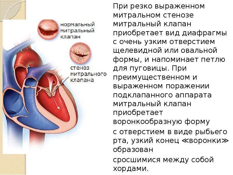 Стеноз митрального клапана презентация - 88 фото