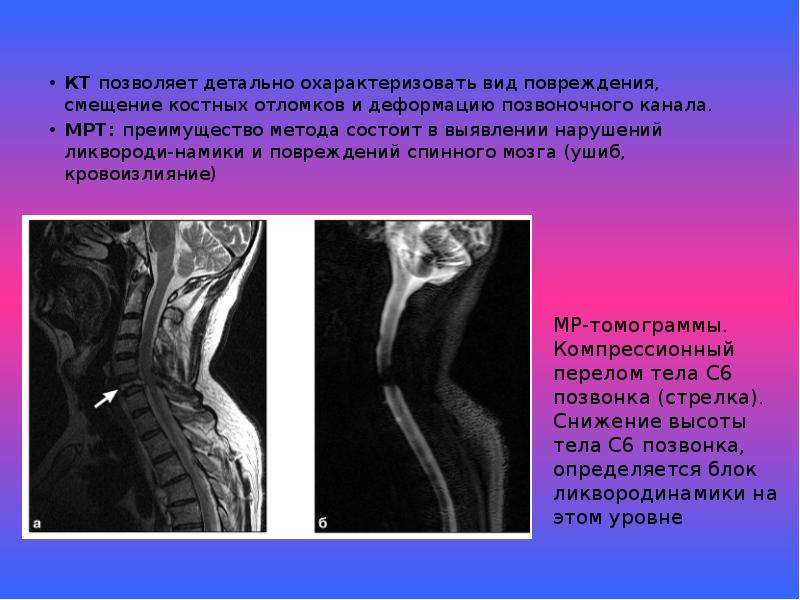 Травмы позвоночника презентация