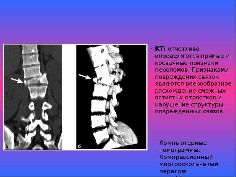 Последствие перелома позвоночника мкб. Перелом остистых отростков позвоночника l1 l2. Перелом остистого отростка с6. Перелом остистого отростка l2 l3. Перелом остистого отростка l5.